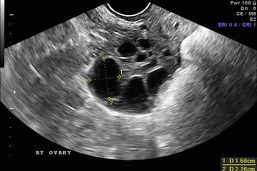 follicular monitering